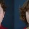 Plastika nosu (Rhinoplastika)