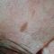 Traitements laser - dermatologie esthétique