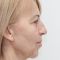 Facelift