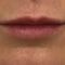 Teosyal, Restylane, Esthelis, Juverdem, Surgiderm (preparáty kyseliny hyaluronovej)