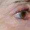 Fotorejuvenace / Resurfacing