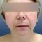 Facelift (operace obličeje), SMAS lifting