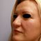 Plastika nosu (Rhinoplastika)