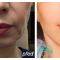 Facelift (operace obličeje), SMAS lifting