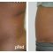 Abdominoplastika (Operace břicha)