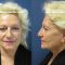 Lifting du visage