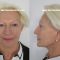 Lifting du visage