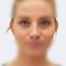 Plastika nosu (Rhinoplastika)