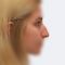 Plastika nosu (Rhinoplastika)