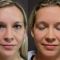 Eyelid surgery (Blepharoplasty)