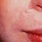 Laser Scar Treatment