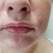 Teosyal, Restylane, Esthelis, Juverdem, Surgiderm (preparáty kyseliny hyaluronovej)