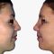 Operácia nosa (Rhinoplastika)