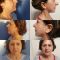 Lifting du visage