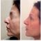 Trattamento Plasma Ricco di Piastrine (PRP)