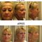 Lifting du visage
