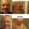 Blépharoplastie