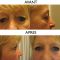 Blépharoplastie
