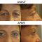Blépharoplastie