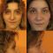Rhinoplastie