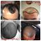 Hair Transplant