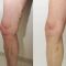 Varicose veins treatment