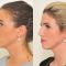 Plastika nosu (Rhinoplastika)