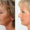 Facelift (operace obličeje), SMAS lifting