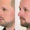 Plastika nosu (Rhinoplastika)
