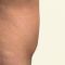 Abdominoplastika (Operace břicha)