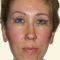 Facelift, SMAS Facelift