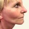 Facelift, SMAS Facelift