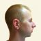 Plastika nosu (Rhinoplastika)