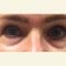 Operace očních víček (Blefaroplastika)