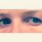 Operace očních víček (Blefaroplastika)