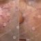 Procedure laser in dermatologia estetica