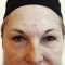 Operace čela (Forehead lift)