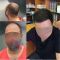 Hair Transplant