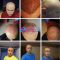 Hair Transplant