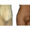 Abdominoplasty (Tummy Tucks)
