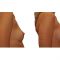 Breast Augmentation - Breast Implants
