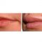 Lip augmentation - cheiloplasty