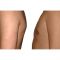 Gynecomastia (Male Breast Reduction)