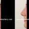 Rhinoplastie médicale