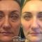 Blépharoplastie