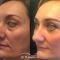 Blépharoplastie