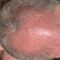 Greffe de cheveux