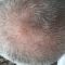 Greffe de cheveux