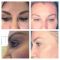 Korekcja powiek (Blepharoplastyka)