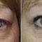 Korekcja powiek (Blepharoplastyka)